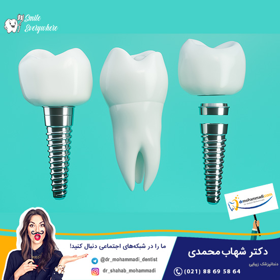 مزایای کاشت دندان به روش ایمپلنت - کلینیک دندانپزشکی دکتر شهاب محمدی